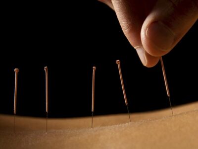 pain relief acupuncture mississauga