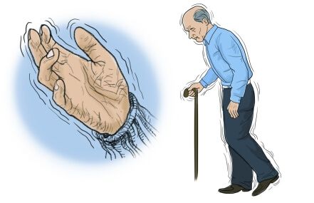 Parkinsons acupuncture Mississauga