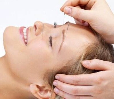 cosmetic acupuncture mississauga