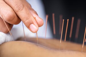 acupuncture for chronic back pain treatment