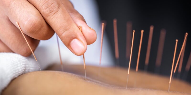 acupuncture for chronic back pain treatment